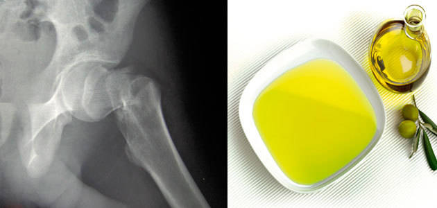 El consumo de AOV reduce un 51% el riesgo de tener una fractura osteoporótica